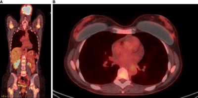 The Therapeutic Challenge of Disseminated Bone Marrow Metastasis From HR-Positive HER2-Negative Breast Cancer: Case Report and Review of the Literature